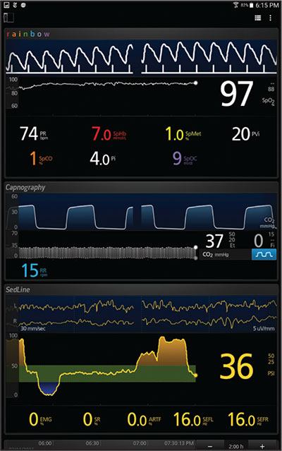 Masimo Kite supplemental display screen